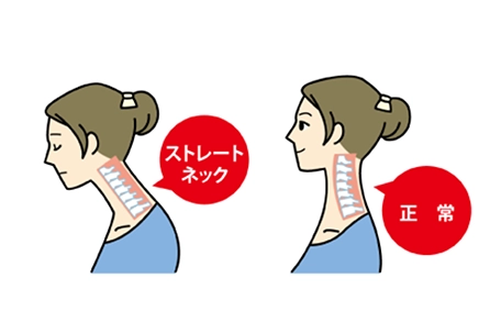 ストレートネックイメージイラスト